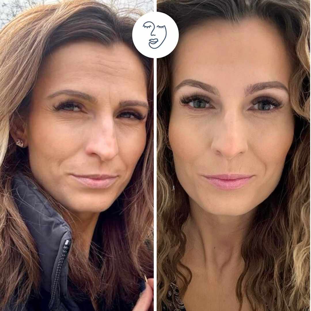 Botox előtte utána